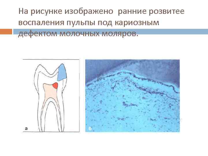 На рисунке изображено ранние розвитее воспаления пульпы под кариозным дефектом молочных моляров. 