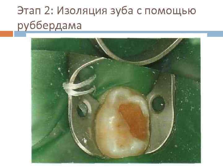 Этап 2: Изоляция зуба с помощью руббердама 