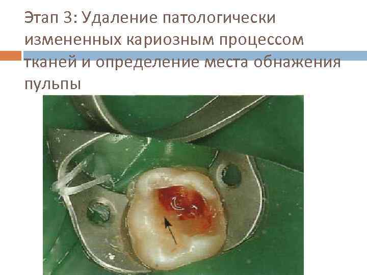 Этап 3: Удаление патологически измененных кариозным процессом тканей и определение места обнажения пульпы 