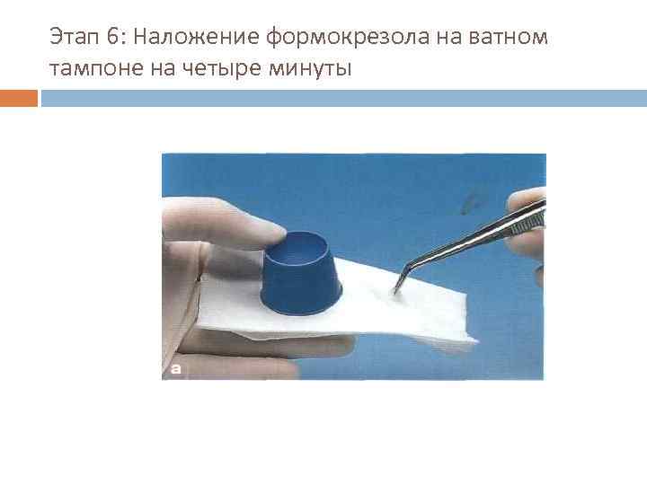 Этап 6: Наложение формокрезола на ватном тампоне на четыре минуты 