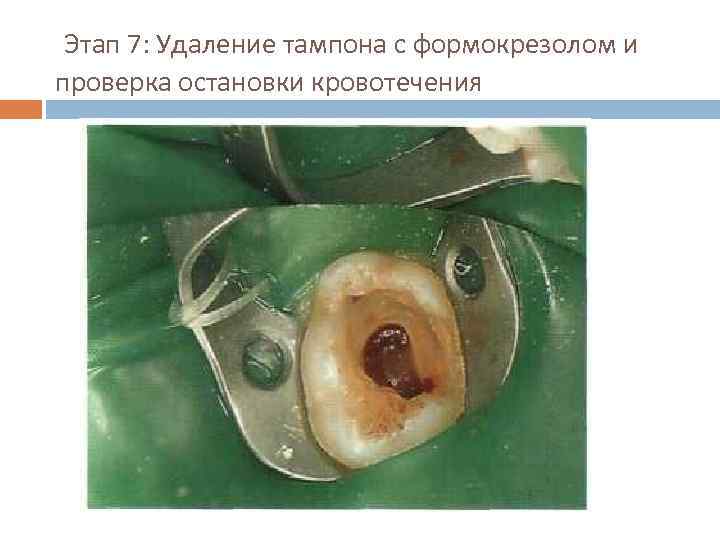 Этап 7: Удаление тампона с формокрезолом и проверка остановки кровотечения 