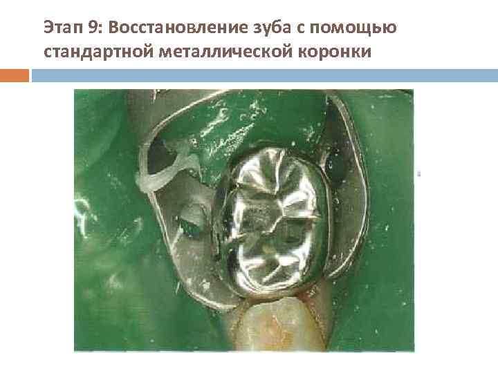 Этап 9: Восстановление зуба с помощью стандартной металлической коронки 