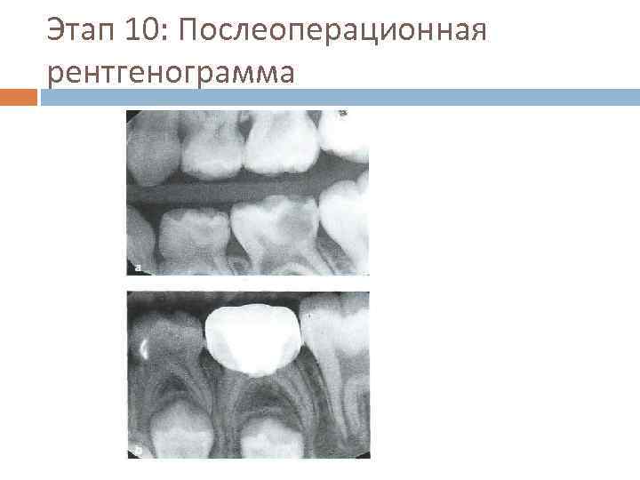 Этап 10: Послеоперационная рентгенограмма 
