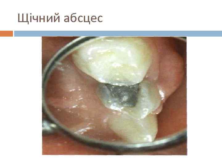 Щічний абсцес 