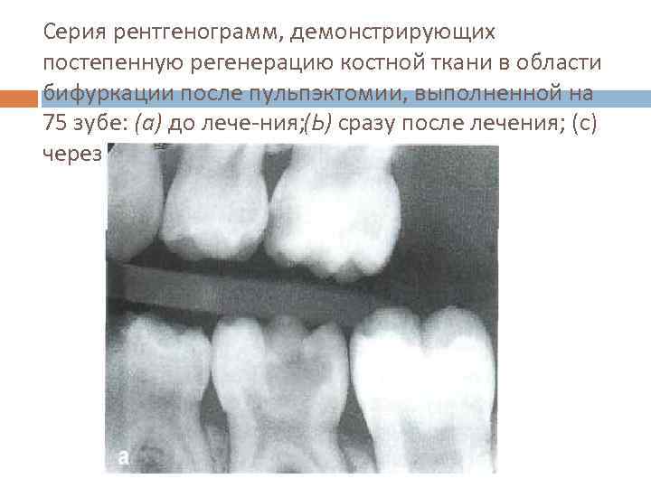 Серия рентгенограмм, демонстрирующих постепенную регенерацию костной ткани в области бифуркации после пульпэктомии, выполненной на