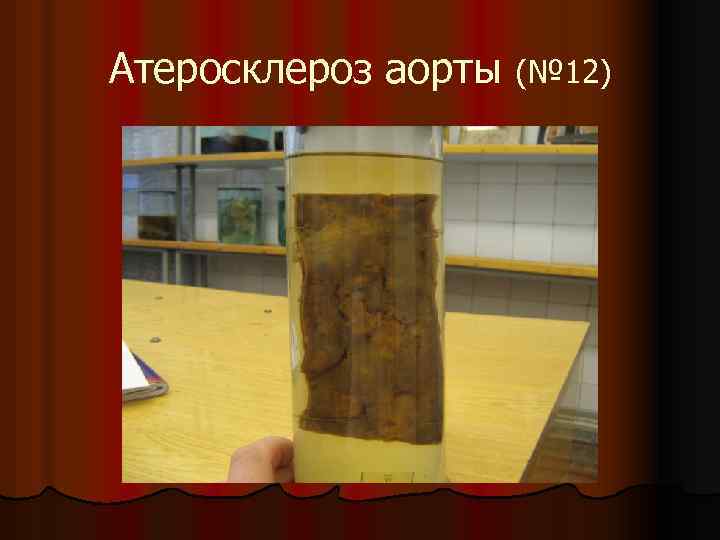 Атеросклероз аорты (№ 12) 