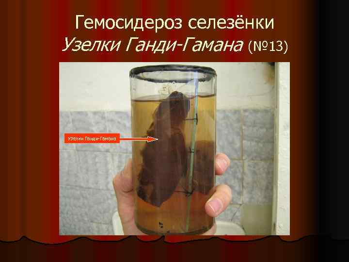 Гемосидероз селезёнки Узелки Ганди-Гамана (№ 13) Узелки Ганди-Гамана 