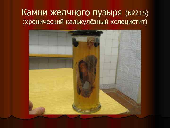 Камни желчного пузыря (№ 215) (хронический калькулёзный холецистит) 