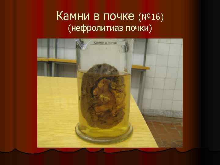 Камни в почке (№ 16) (нефролитиаз почки) 