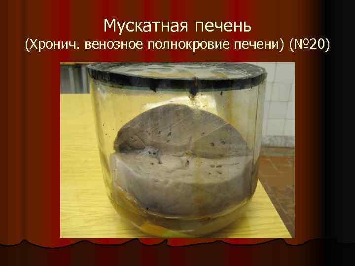 Мускатная печень (Хронич. венозное полнокровие печени) (№ 20) 