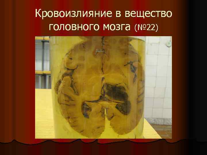 Кровоизлияние в вещество головного мозга (№ 22) 