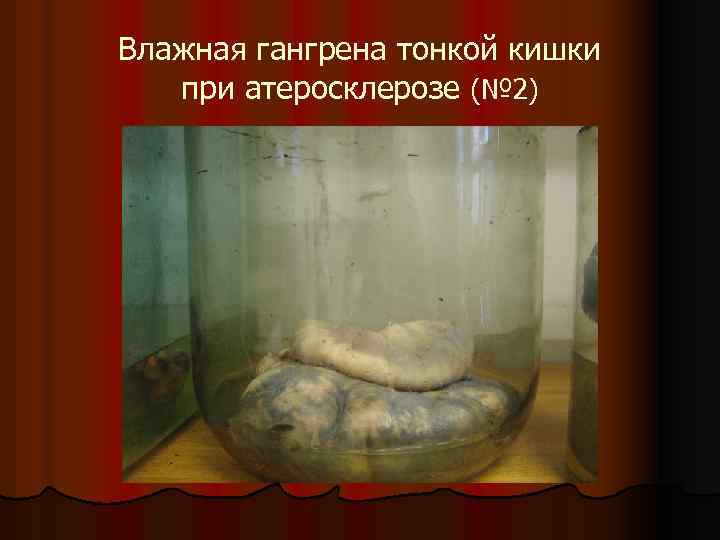 Влажная гангрена тонкой кишки при атеросклерозе (№ 2) 