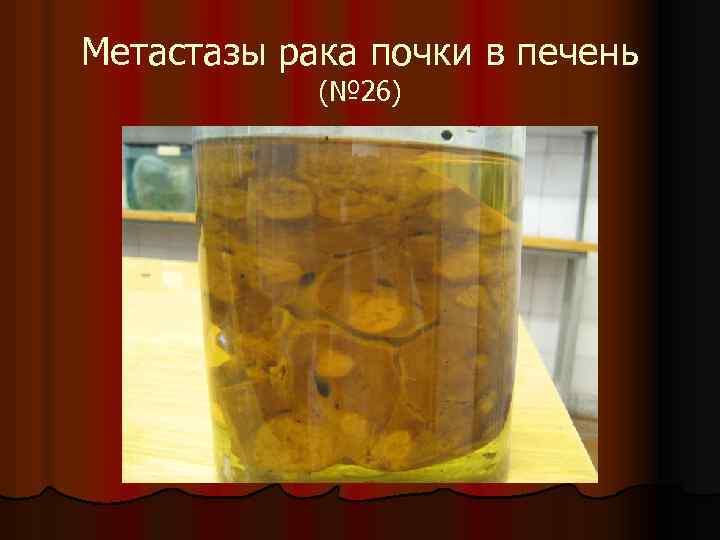 Метастазы рака почки в печень (№ 26) 