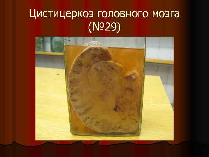 Цистицеркоз головного мозга (№ 29) 
