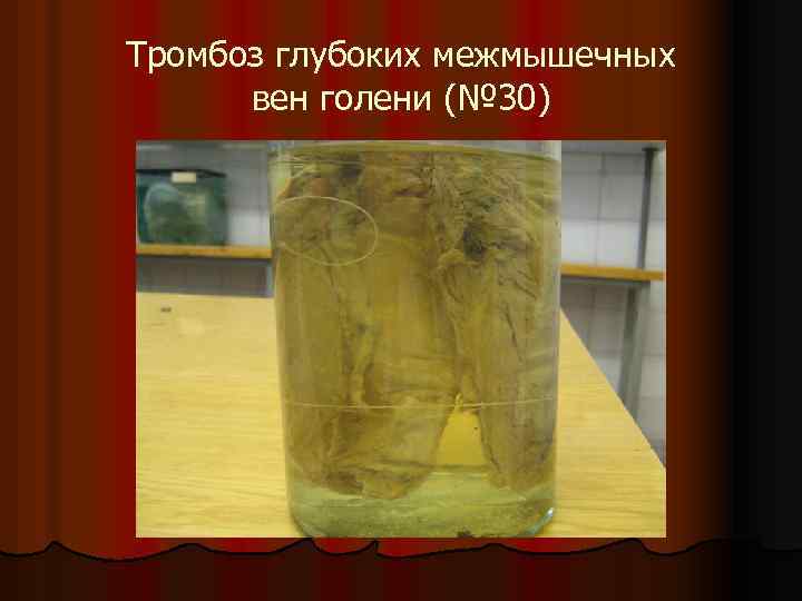 Тромбоз глубоких межмышечных вен голени (№ 30) 