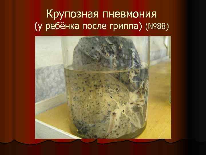 Крупозная пневмония (у ребёнка после гриппа) (№ 88) 