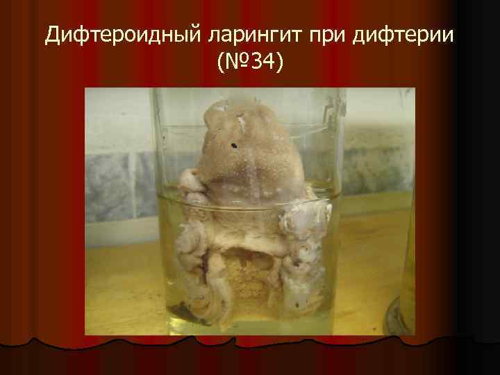 Дифтероидный ларингит при дифтерии (№ 34) 