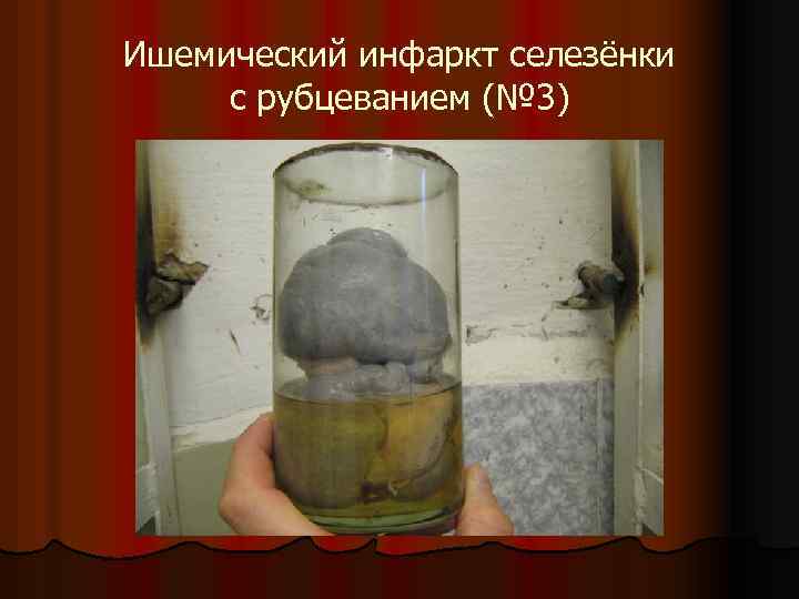 Ишемический инфаркт селезёнки с рубцеванием (№ 3) 