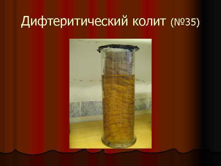 Дифтеритический колит (№ 35) 