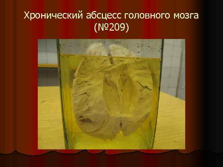 Хронический абсцесс головного мозга (№ 209) 