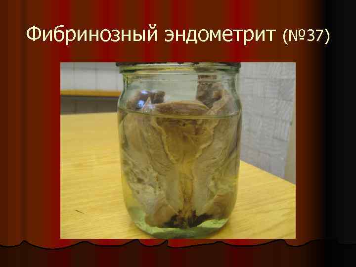 Фибринозный эндометрит (№ 37) 