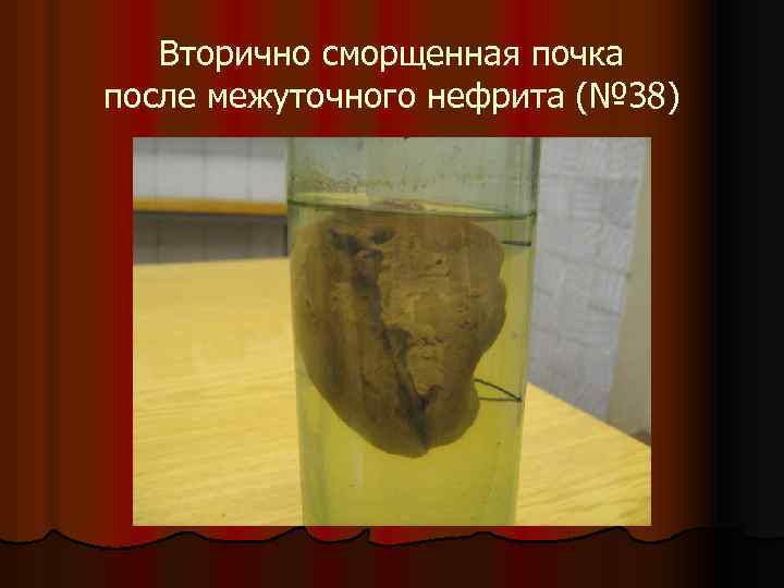 Вторично сморщенная почка после межуточного нефрита (№ 38) 