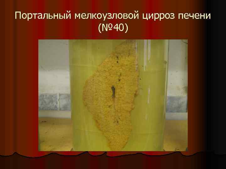 Портальный мелкоузловой цирроз печени (№ 40) 