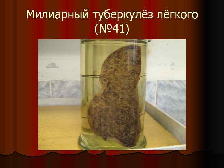 Милиарный туберкулёз лёгкого (№ 41) 