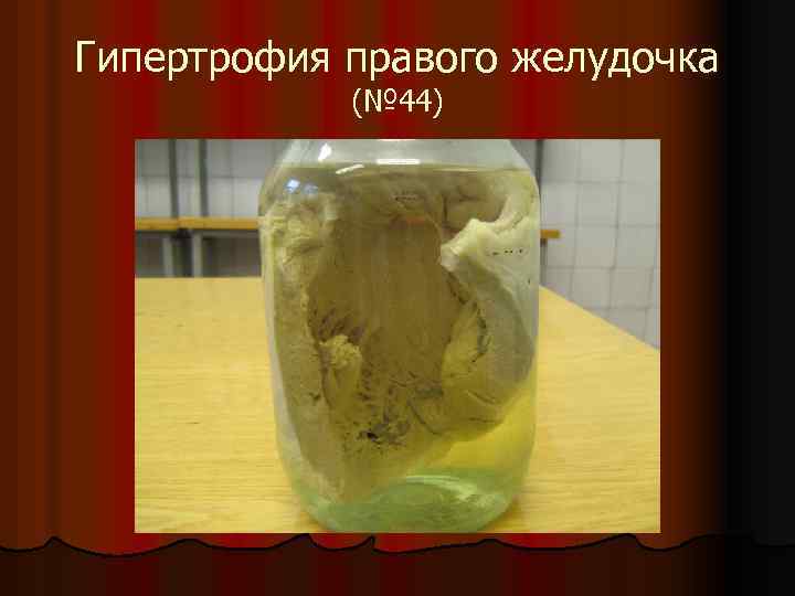 Гипертрофия правого желудочка (№ 44) 