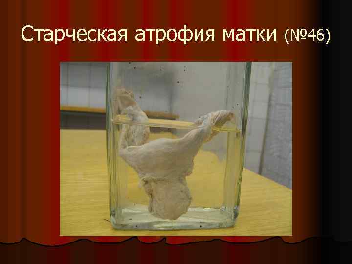 Старческая атрофия матки (№ 46) 