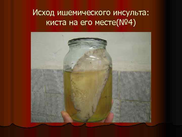 Исход ишемического инсульта: киста на его месте(№ 4) 