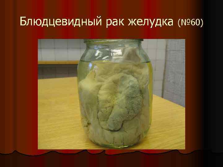 Блюдцевидный рак желудка (№ 60) 