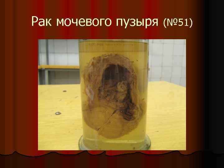 Рак мочевого пузыря (№ 51) 