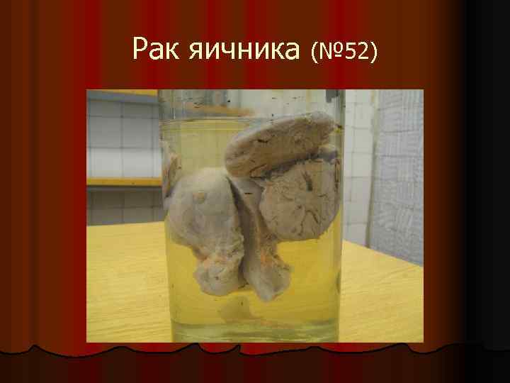 Рак яичника (№ 52) 