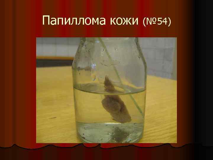 Папиллома кожи (№ 54) 