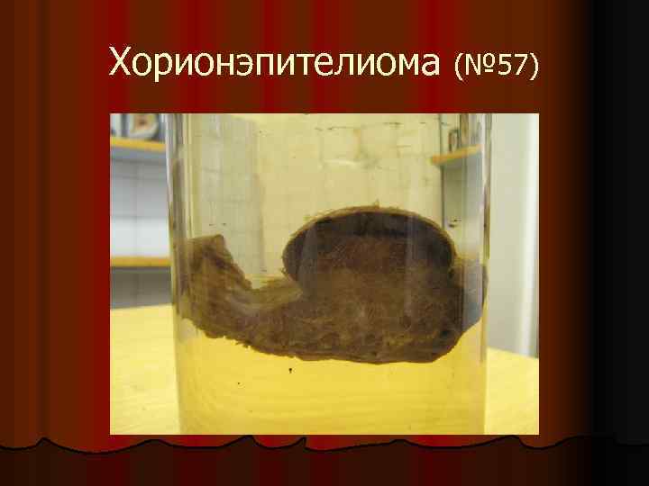 Хорионэпителиома (№ 57) 