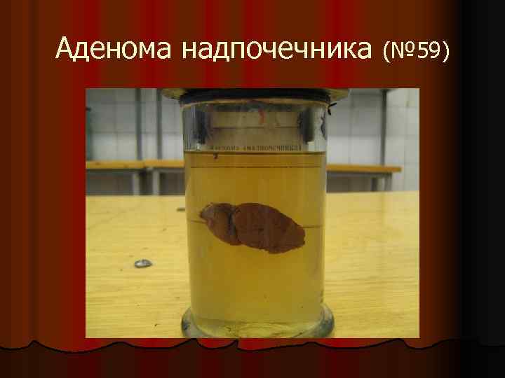 Аденома надпочечника (№ 59) 