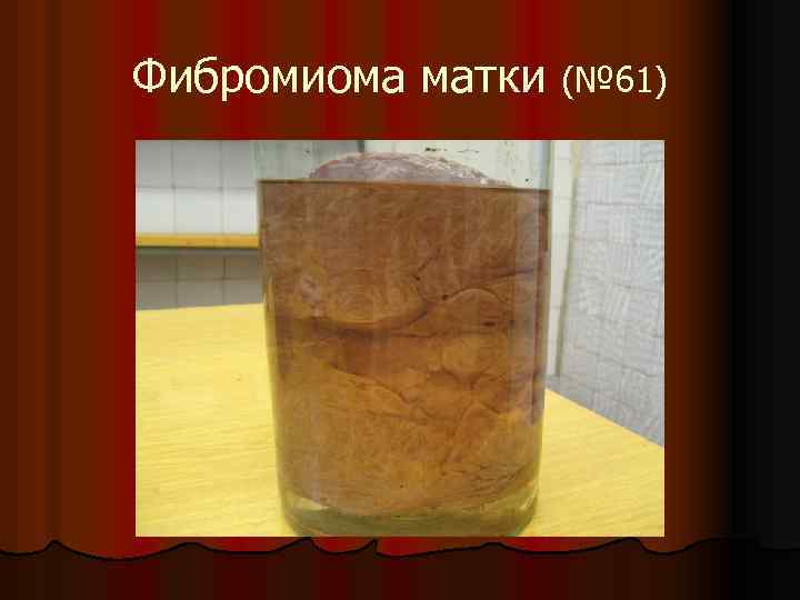 Фибромиома матки (№ 61) 