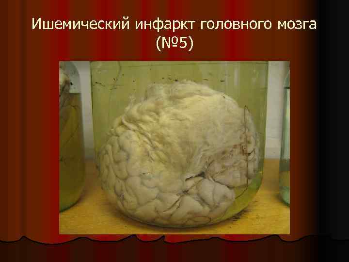 Ишемический инфаркт головного мозга (№ 5) 