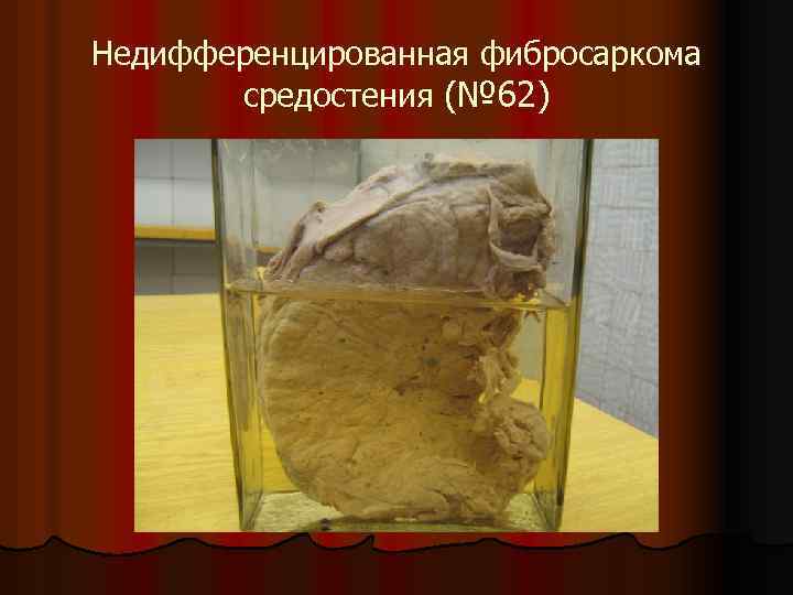 Недифференцированная фибросаркома средостения (№ 62) 