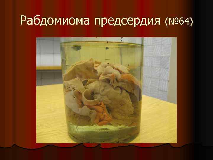 Рабдомиома предсердия (№ 64) 