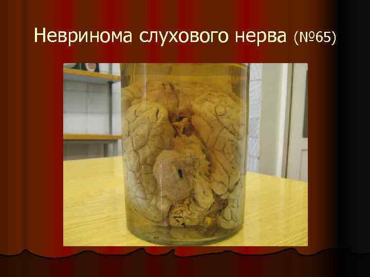 Невринома слухового нерва (№ 65) 