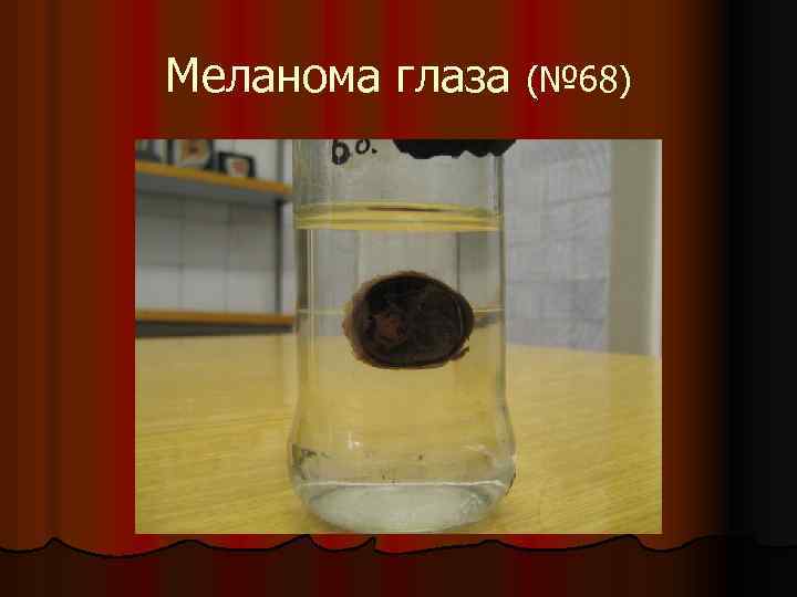 Меланома глаза (№ 68) 