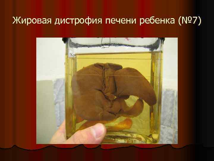 Жировая дистрофия печени ребенка (№ 7) 