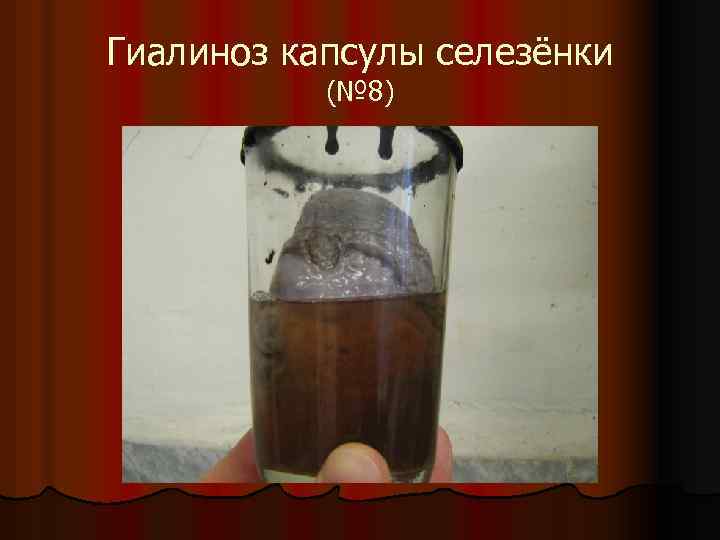 Гиалиноз капсулы селезёнки (№ 8) 