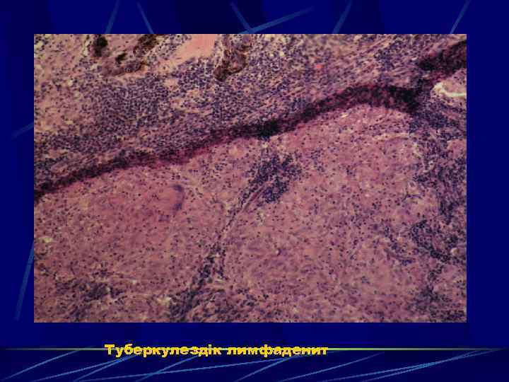 Туберкулездік лимфаденит 