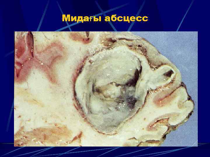 Мидағы абсцесс 