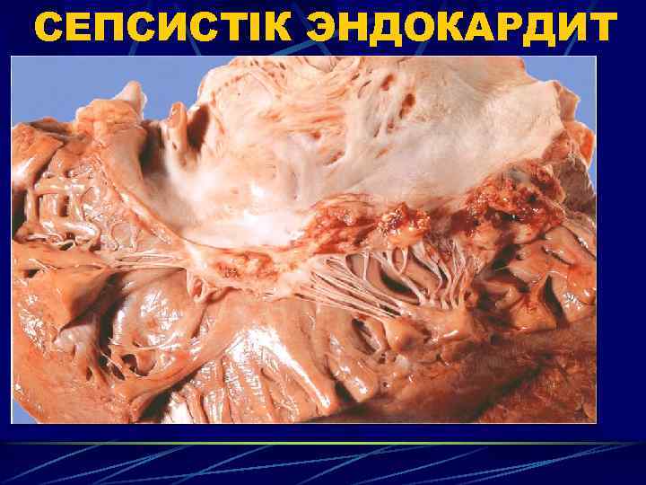 СЕПСИСТІК ЭНДОКАРДИТ 