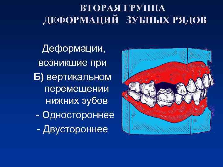 ВТОРАЯ ГРУППА ДЕФОРМАЦИЙ ЗУБНЫХ РЯДОВ Деформации, возникшие при Б) вертикальном перемещении нижних зубов -