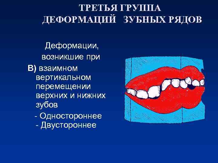 ТРЕТЬЯ ГРУППА ДЕФОРМАЦИЙ ЗУБНЫХ РЯДОВ Деформации, возникшие при В) взаимном вертикальном перемещении верхних и